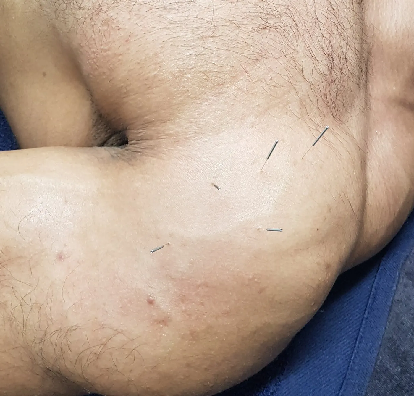 Fine acupuncture needles in place across the deltoid and upper chest during a medical acupuncture session
